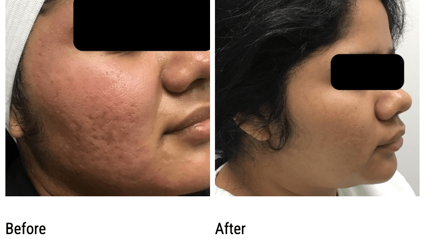Before and After Photos of Mic